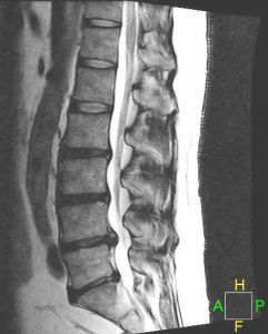 lumbar-discherniation-lateral-View